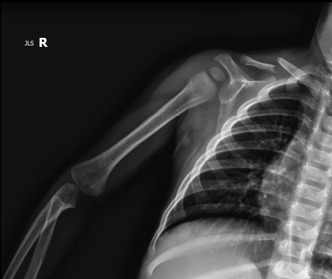 Toddler Clavicle Fracture