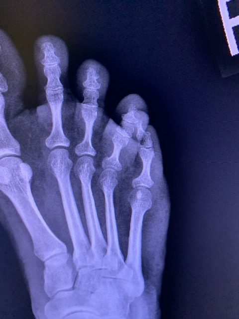 Repairing a dislocated toe and relationship with God